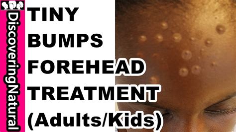 HOW TO GET RID OF TINY BUMPS ON FOREHEAD in 10 DAYS | Acne, Pimple ...