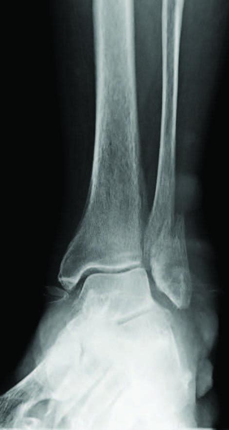 Early Weight-Bearing Following Ankle Fracture ORIF