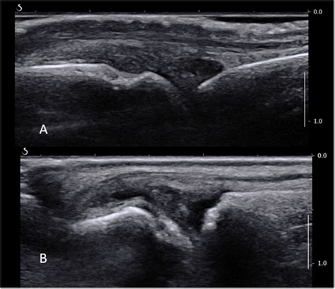 (A) Normal MCP joint on a longitudinal ultrasound view. Note the joint ...