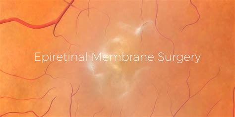 Epiretinal Membrane (ERM) Surgery: Everything You Need to Know | Island ...