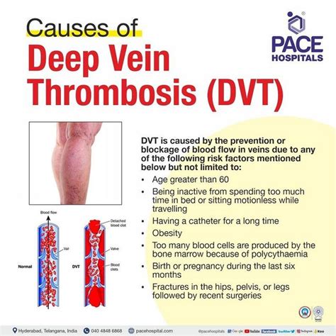 Deep Vein Thrombosis, DVT Symptoms, Causes And, 59% OFF