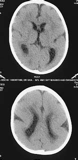 Lissencephaly-CT - Sumer's Radiology Blog