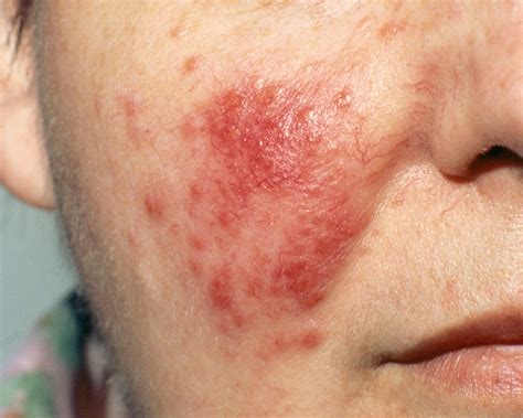 7 Causes of Red Spots and Bumps on Skin, With Pictures | Allure