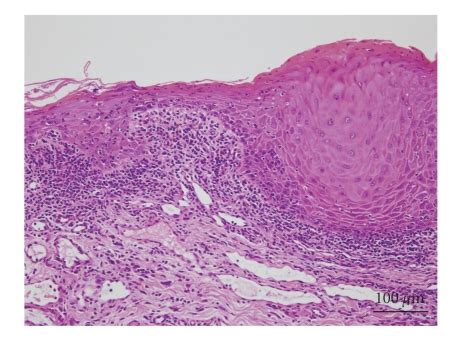 Histological findings of the oral lesion. Severe lichenoid dermatitis ...