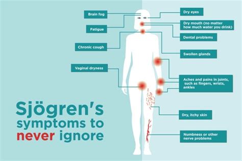 Sjögren’s Syndrome Symptoms You Might Be Ignoring