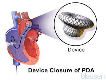 Patent Ductus Arteriosus (PDA) - Pediatrics - MSD Manual Professional ...