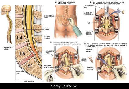 Lower Back Surgery - L5 S1 Lumbar Disc Herniation with Discectomy Stock ...