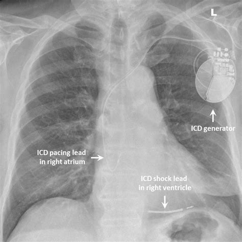 ICD Basics - RCEMLearning India