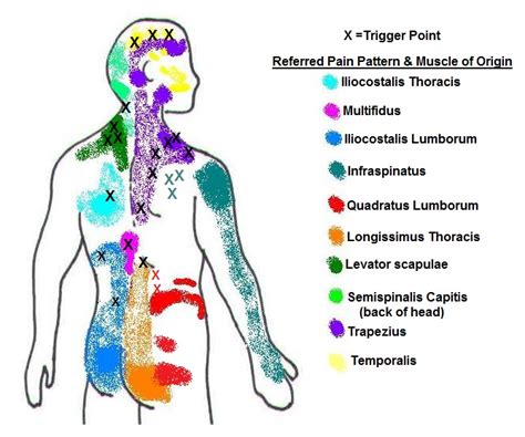 Referred Pain Chart Anatomy