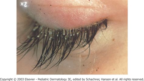 26 New What Causes Eyelash Lice - Demodectic Mange