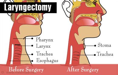 Laryngectomy - Procedure, Risks and Post Laryngectomy Therapy