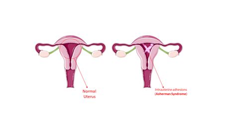 Intrauterine Adhesions (Asherman Syndrome): Infertility and Recurrent ...