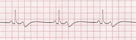 Bradycardia training - video | ProCPR