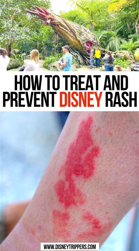 How To Treat And Prevent Disney Rash | Disney rash, Disney vacation ...