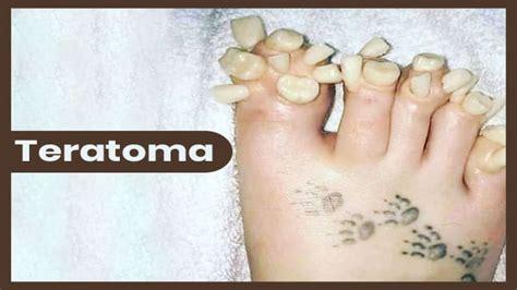 Teratoma: Types, Symptoms, Causes, Diagnosis And Treatment - Boldsky.com