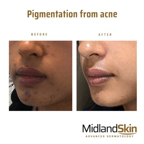 Acne Pigmentation Treatment in Birmingham by Dermatologists