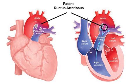 Anaesthesia for patent ductus arteriosus ligation in children : WFSA ...