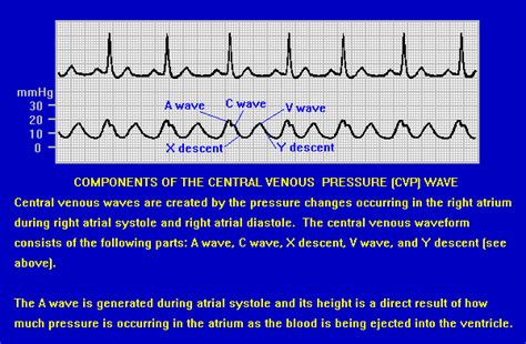 CVP waveform | Emergency nursing, Central venous pressure, Respiratory ...