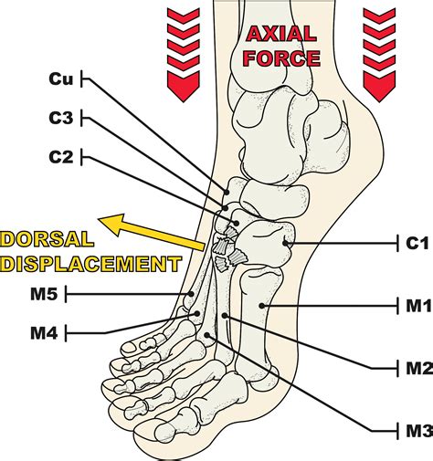 Evaluation of the Tarsometatarsal Joint Using Conventional Radiography ...