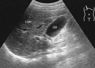 Abdominal Ultrasound Imaging: Anatomy, Physics, Instrumentation, and ...