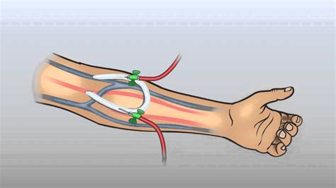 MEDICINE: The arteriovenous (AV) graft part 1