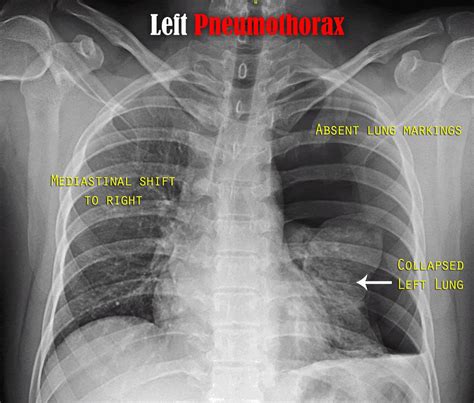 Chest X Ray Mild Pneumothorax