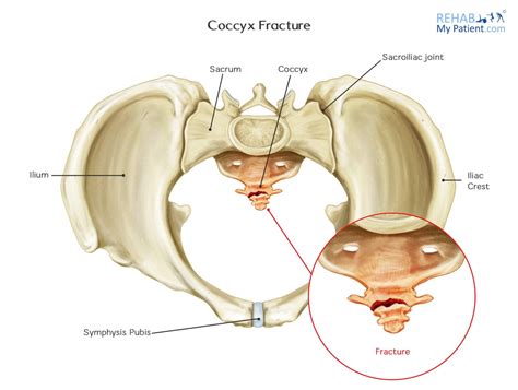 Coccyx Fracture | Rehab My Patient