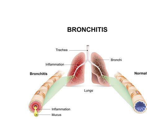 Acute Bronchitis - Harvard Health