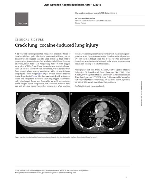 (PDF) Crack Lung: Cocaine induced lung injury