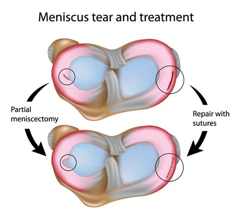 knee-meniscus-teat-arthroscopy - The Orthopedic & Sports Medicine ...