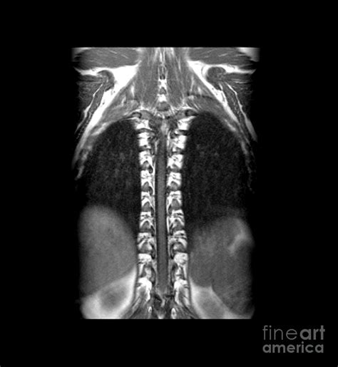 Normal Mri Of Thoracic Spinal Cord Photograph by Medical Body Scans ...