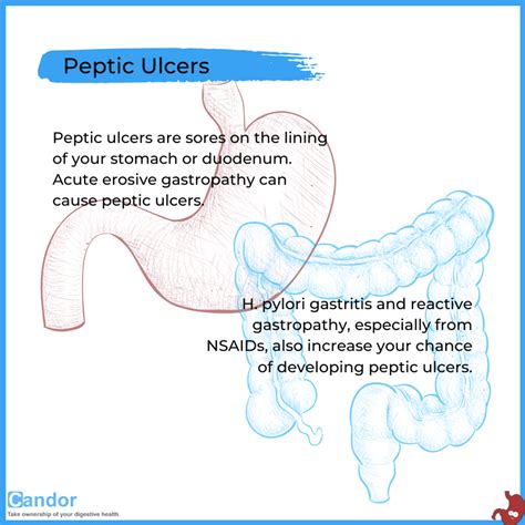 What are the Complications of Gastritis and Gastropathy? - Candor