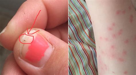 Mom shares terrifying photos of 3-year-old covered in "seed ticks ...