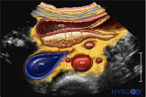 Ultrasound-Guided Celiac Plexus Block and Neurolysis - NYSORA | NYSORA