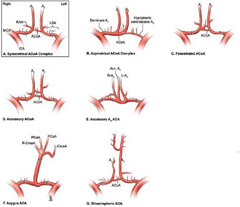 Anterior Communicating Artery Aneurysms | Neupsy Key