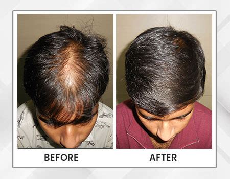 Hair loss treatment in Kolkata - hair treatment in Kolkata - Dr. Paul's