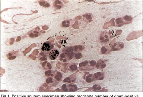 Figure 4 from Interpreting the Sputum Gram Stain Report | Semantic Scholar