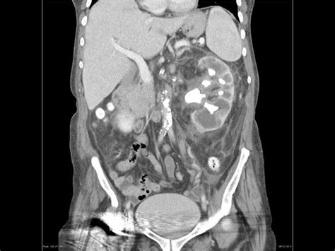 Perinephric abscess imaging