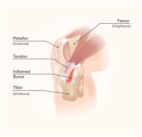 Pes anserine bursitis - volthoughts