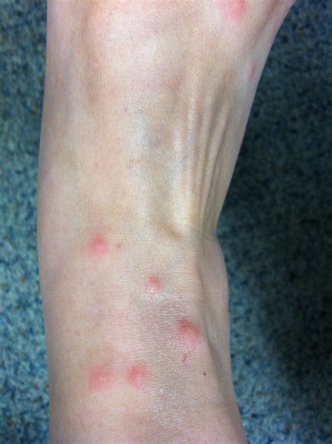 Chigger Bites on Ankles and Feet - Summers Acres