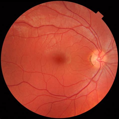 Fundus_photograph_of_normal_right_eye - Doris Lu, Optometrist