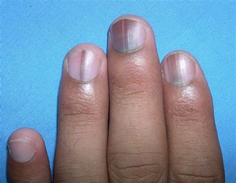 Melanonychia on Nails: Symptoms, Causes & Treatment