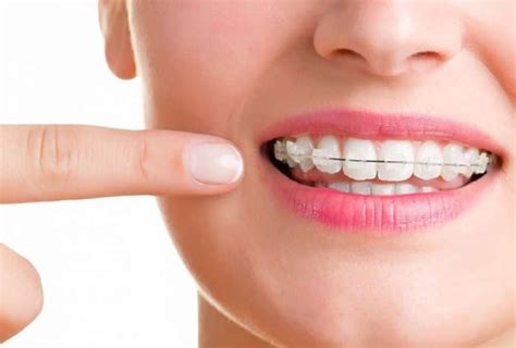 Pros and Cons of At-Home Teeth Aligners - GudStory.com