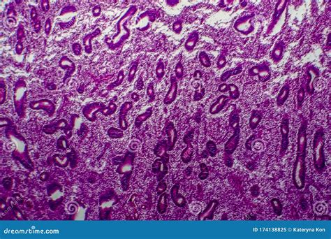 Endometrial Hyperplasia, Light Micrograph Stock Image - Image of glands ...