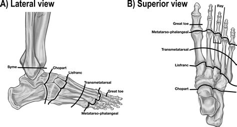 Association between the level of partial foot amputation and gait: a ...