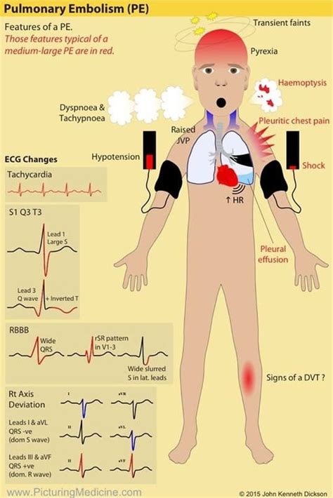 Pulmonary Thromboembolism and Thrombolytics - Manual of Medicine