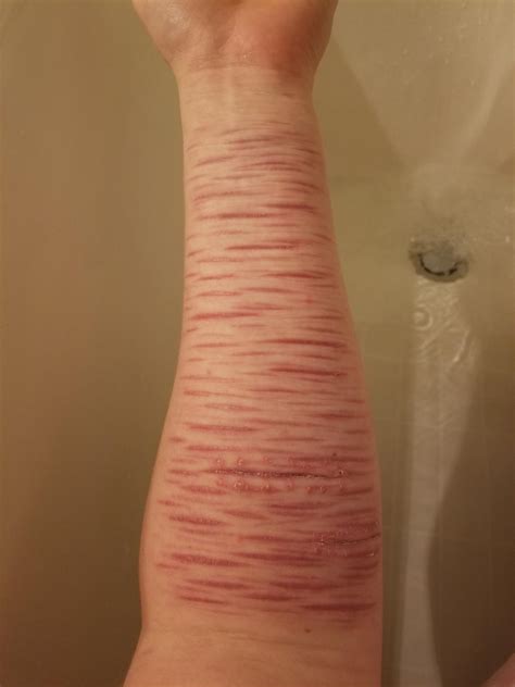 scars ft recent stitches : r/SelfHarmScars