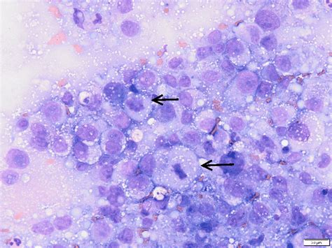 Neck Lymph Node Biopsy