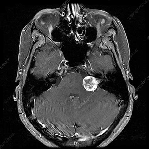 Schwannoma Mri