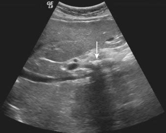 Chronic Pancreatitis Ultrasound